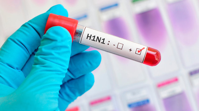 «Խոզի գրիպը» վերադառնում է. Վրաստանում H1N1 գրիպի վիրուսից երկու մարդ է մահացել